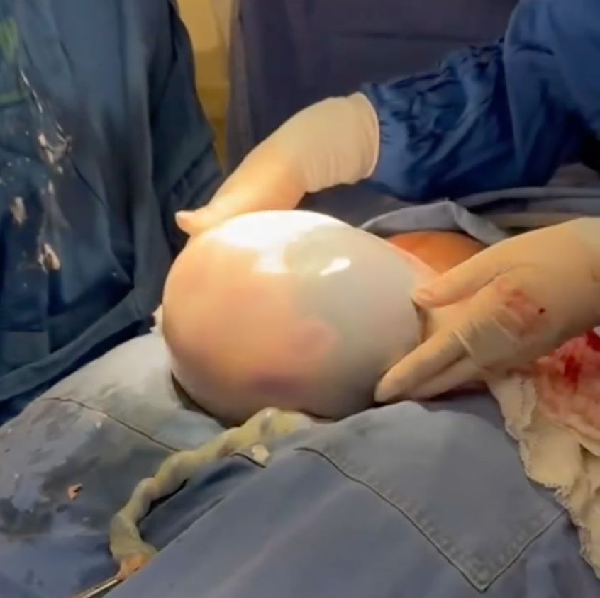 bebê nasce empelicado durante parto em hospital do interior de Goiás